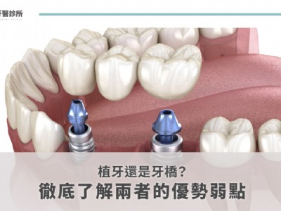 植牙還是牙橋？徹底了解兩者的優勢弱點