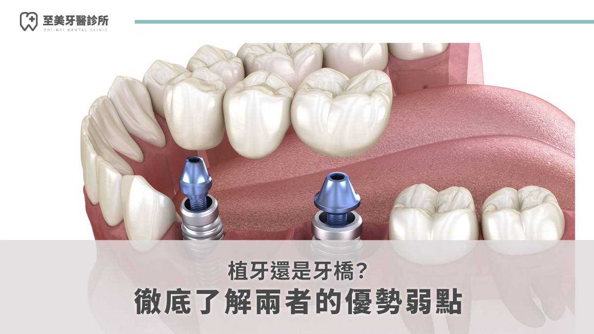 植牙還是牙橋？徹底了解兩者的優勢弱點